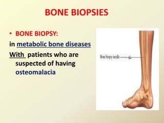 BONE BIOPSIES
• BONE BIOPSY:
in metabolic bone diseases
With patients who are
suspected of having
osteomalacia
 
