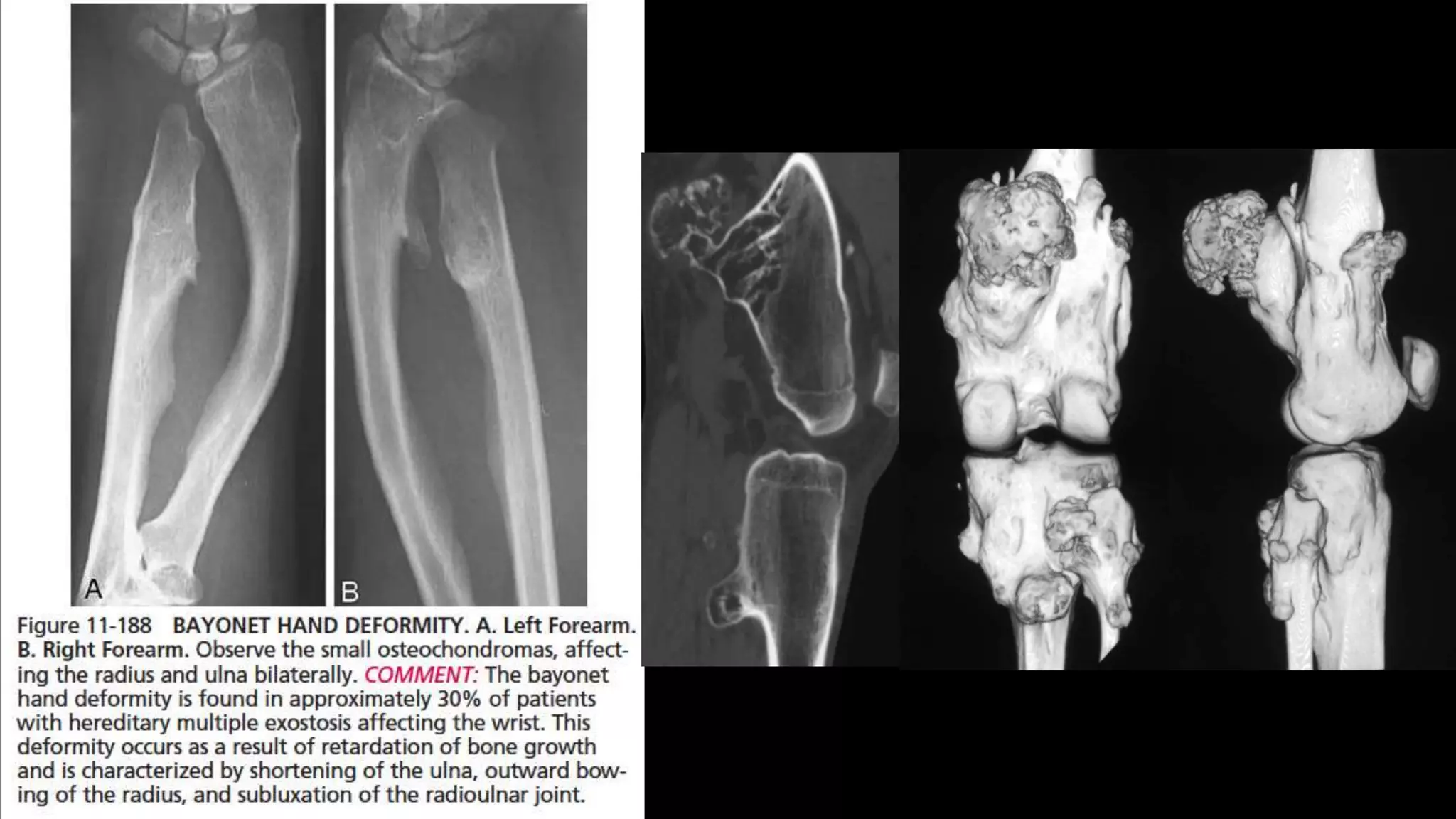 Imaging of benign bone tumors | PPTX