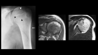 Imaging of benign bone tumors | PPTX
