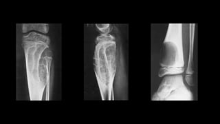 Imaging of benign bone tumors | PPTX