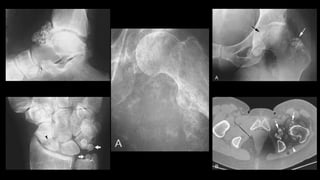 Imaging of benign bone tumors | PPTX