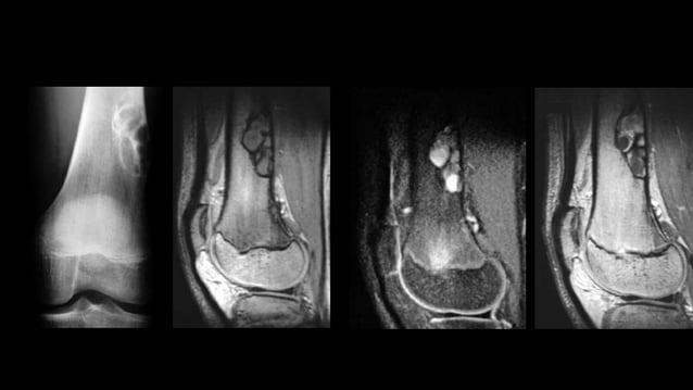 Imaging of benign bone tumors | PPTX
