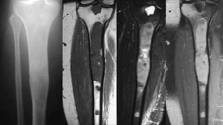 Imaging of benign bone tumors | PPTX