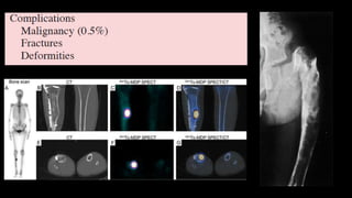 Imaging of benign bone tumors | PPTX