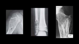 Imaging of benign bone tumors | PPTX
