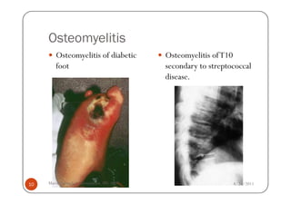 Osteomyelitis
        Osteomyelitis of diabetic         Osteomyelitis of T10
        foot                              secondary to streptococcal
                                          disease.




10   Maria Carmela L. Domocmat, RN, MSN                       8/24/2011
 