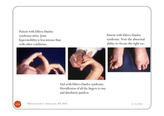 Patient with Ehlers-Danlos
  syndrome mitis. Joint                                                      Patient with Ehlers-Danlos
  hypermobility is less intense than                                         syndrome. Note the abnormal
  with other conditions.                                                     ability to elevate the right toe.




                                   Girl with Ehlers-Danlos syndrome.
                                   Dorsiflexion of all the fingers is easy
                                   and absolutely painless.


102     Maria Carmela L. Domocmat, RN, MSN                                                        8/24/2011
 