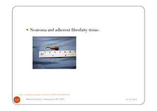 Neuroma and adherent fibrofatty tissue.




      http://emedicine.medscape.com/article/308284-clinical#showall

112           Maria Carmela L. Domocmat, RN, MSN                      8/24/2011
 