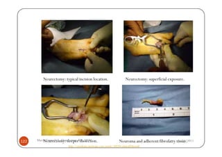 Neurectomy: typical incision location.                         Neurectomy: superficial exposure.




122   Maria Carmela L. Domocmat, RN, MSN
          Neurectomy: deeper dissection.                          Neuroma and adherent fibrofatty tissue.
                                                                                                   8/24/2011
                       http://emedicine.medscape.com/article/308284-clinical#showall
 