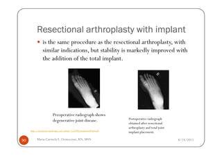 Resectional arthroplasty with implant
                is the same procedure as the resectional arthroplasty, with
                similar indications, but stability is markedly improved with
                the addition of the total implant.




                         Preoperative radiograph shows
                                                                       Postoperative radiograph
                         degenerative joint disease.
                                                                       obtained after resectional
                                                                       arthroplasty and total joint
     http://emedicine.medscape.com/article/1232902-treatment#showall
                                                                       implant placement.

90        Maria Carmela L. Domocmat, RN, MSN                                                          8/24/2011
 
