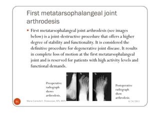 First metatarsophalangeal joint
     arthrodesis
        First metatarsophalangeal joint arthrodesis (see images
        below) is a joint-destructive procedure that offers a higher
        degree of stability and functionality. It is considered the
        definitive procedure for degenerative joint disease. It results
        in complete loss of motion at the first metatarsophalangeal
        joint and is reserved for patients with high activity levels and
        functional demands.


                     Preoperative
                                                          Postoperative
                     radiograph
                                                          radiograph
                     shows
                                                          show
                     arthrodesis.
                                                          arthrodesis.
91   Maria Carmela L. Domocmat, RN, MSN                            8/24/2011
 