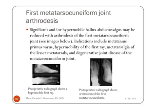 First metatarsocuneiform joint
     arthrodesis
        Significant and/or hypermobile hallux abductovalgus may be
        reduced with arthrodesis of the first metatarsocuneiform
        joint (see images below). Indications include metatarsus
        primus varus, hypermobility of the first ray, metatarsalgia of
        the lesser metatarsals, and degenerative joint disease of the
        metatarsocuneiform joint.




      Preoperative radiograph shows a     Postoperative radiograph shows
      hypermobile first ray.              arthrodesis of the first
92   Maria Carmela L. Domocmat, RN, MSN   metatarsocuneiform.              8/24/2011
 