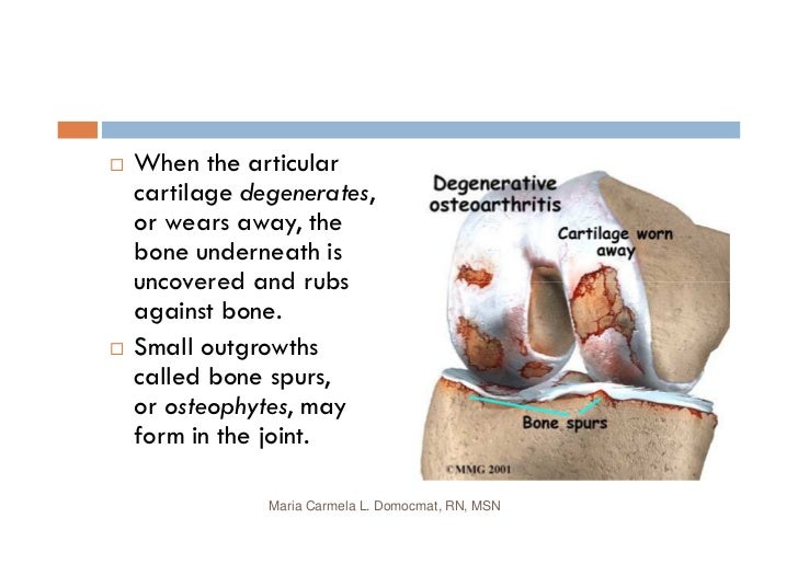 Osteoarthritis & Gouty Arthritis