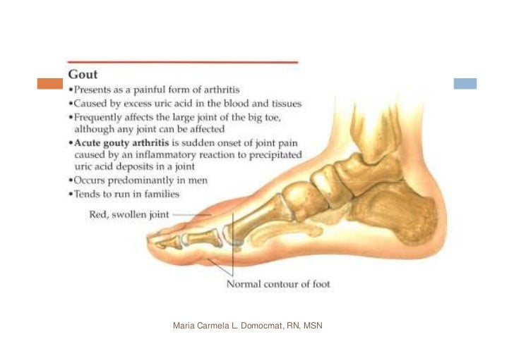 Osteoarthritis & Gouty Arthritis