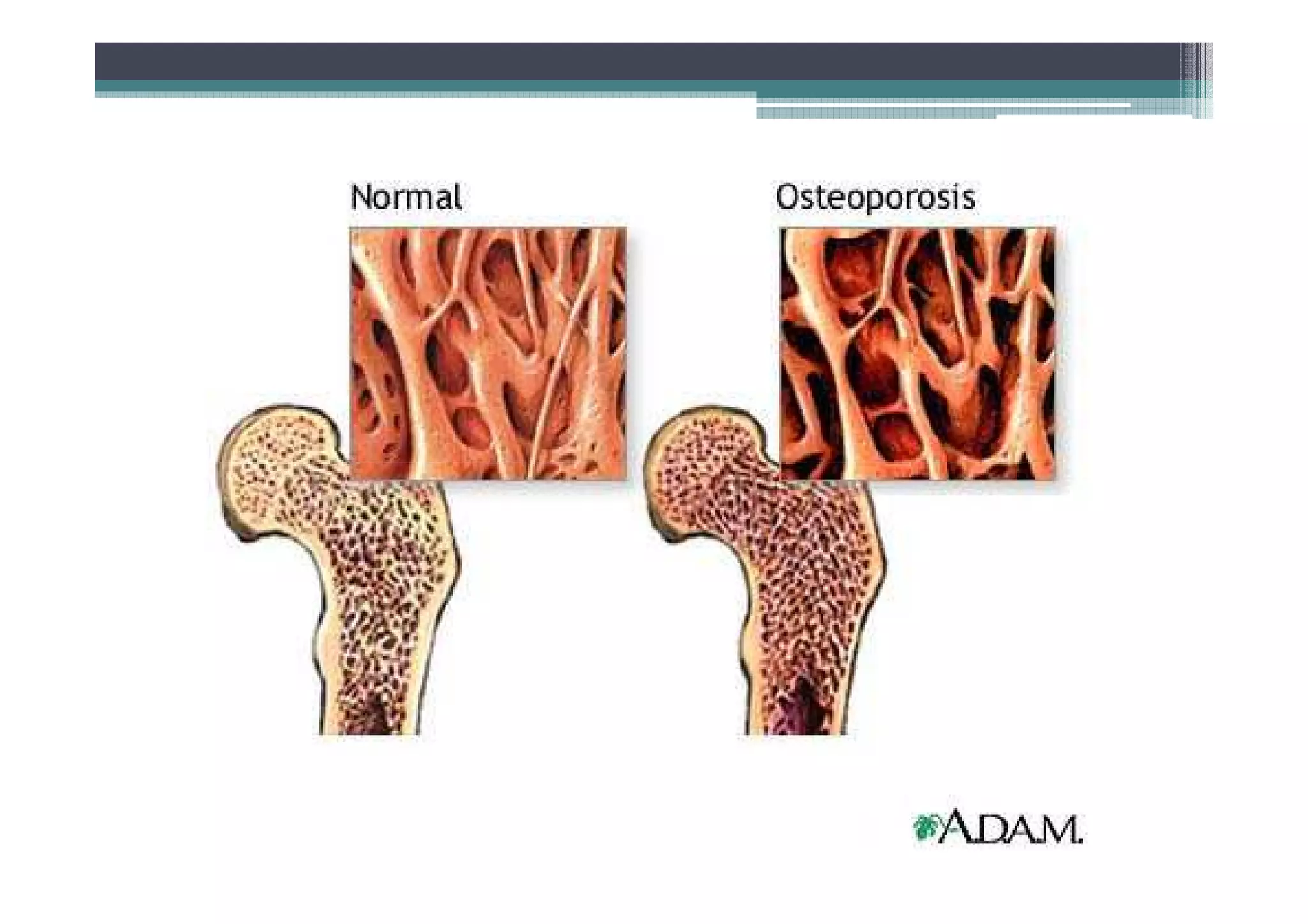 Photo inspiration: Fresh Look at Osteoporosis Osteomalacia Paget S Disease