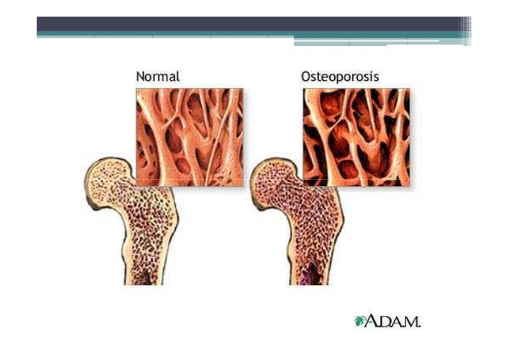 Osteoporosis, Osteomalacia, Paget's disease