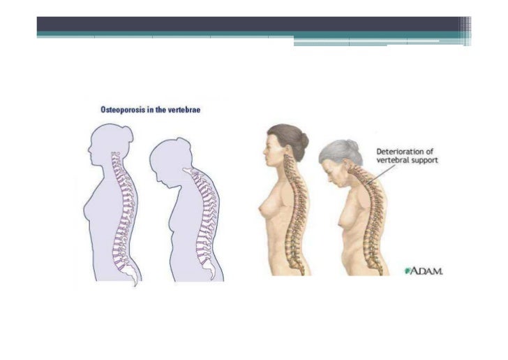 Osteoporosis, Osteomalacia, Paget's disease