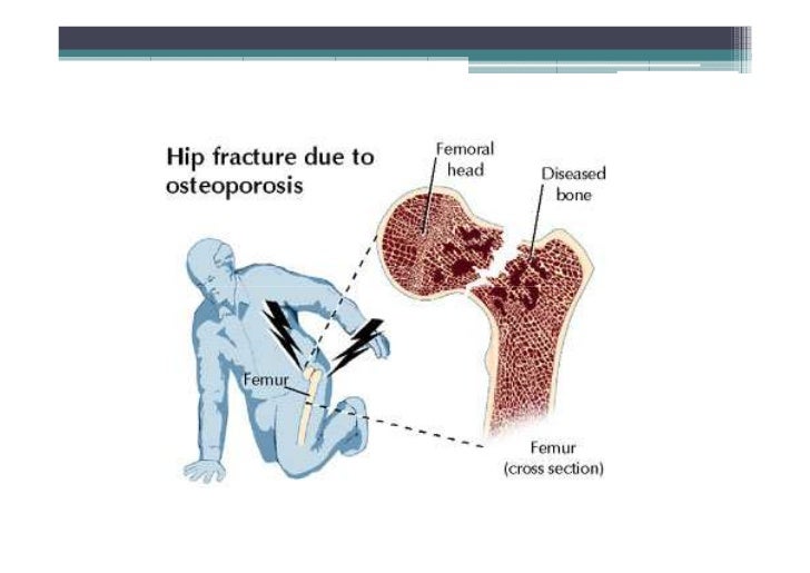 Osteoporosis, Osteomalacia, Paget's disease
