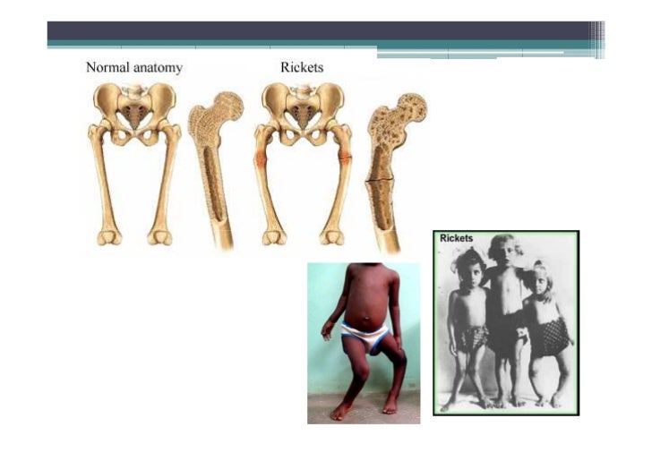 Osteoporosis, Osteomalacia, Paget's disease