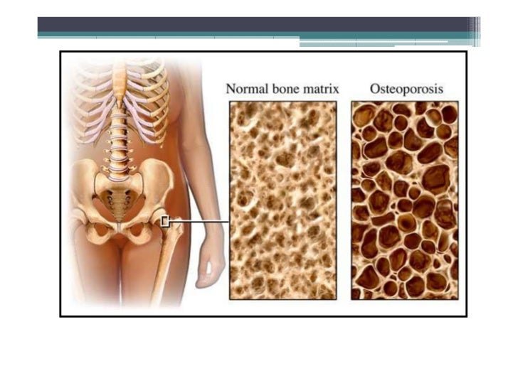 Osteoporosis, Osteomalacia, Paget's disease