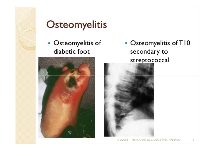 Strep infection in bone