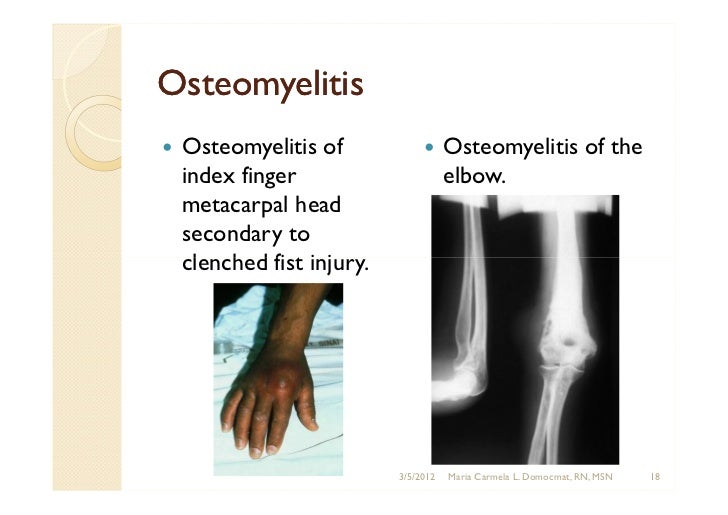 Bone and joint infections: Osteomyelitis, Septic Arthritis