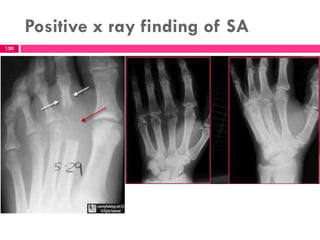 Positive x ray finding of SA
150
 