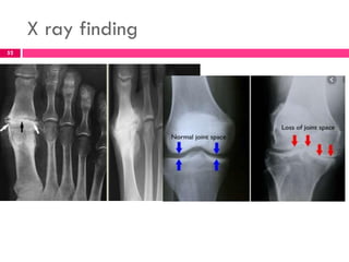 X ray finding
52
 