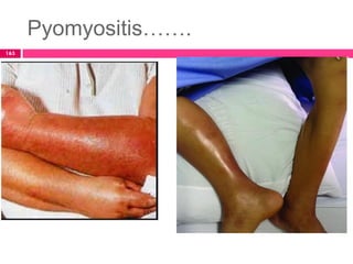 Pyomyositis…….
163
 