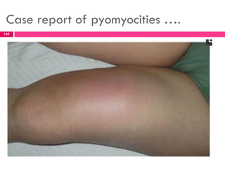 Case report of pyomyocities ….
169
 