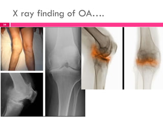 X ray finding of OA….
54
 