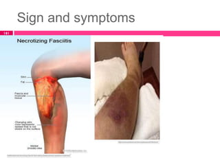 Sign and symptoms
181
 