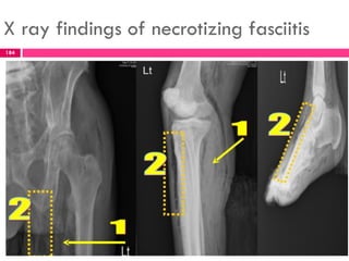 X ray findings of necrotizing fasciitis
184
 