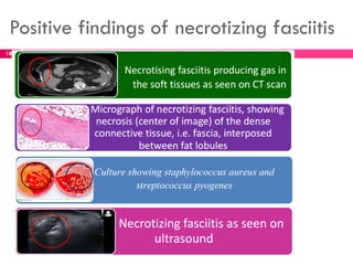 Positive findings of necrotizing fasciitis
185
 