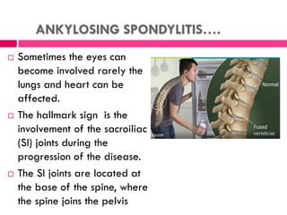 ANKYLOSING SPONDYLITIS….
 Sometimes the eyes can
become involved rarely the
lungs and heart can be
affected.
 The hallmark sign is the
involvement of the sacroiliac
(SI) joints during the
progression of the disease.
 The SI joints are located at
the base of the spine, where
the spine joins the pelvis
 