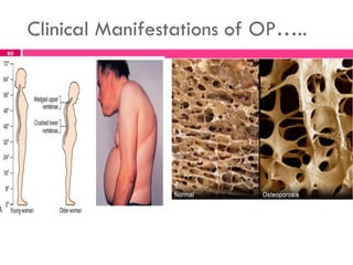Clinical Manifestations of OP…..
80
 