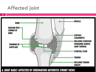 Affected joint
88
 