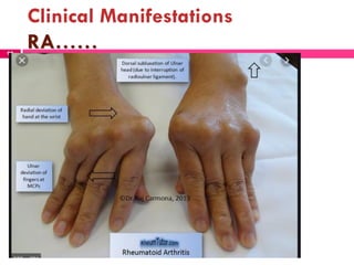 Clinical Manifestations
RA……99
 
