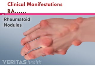 Clinical Manifestations
RA……100
 