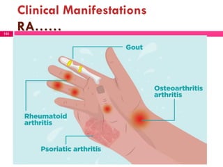 Clinical Manifestations
RA……101
 