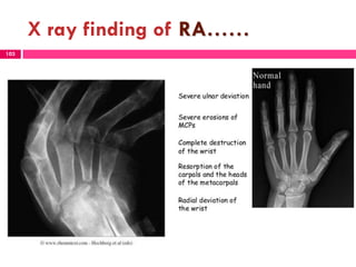 X ray finding of RA……
103
 