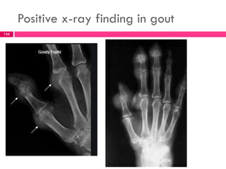 Positive x-ray finding in gout
134
 