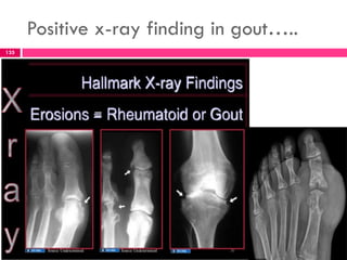 Positive x-ray finding in gout…..
135
 