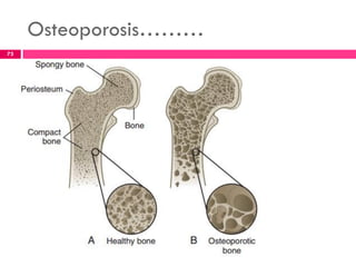 Osteoporosis………
73
 