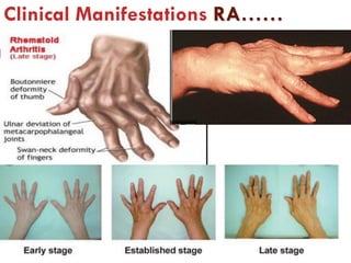 Clinical Manifestations RA……
98
 