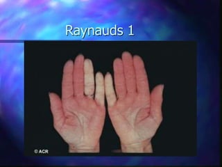Raynauds 1
 