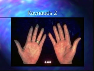 Raynauds 2
 