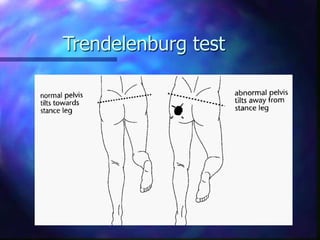 Trendelenburg test
 