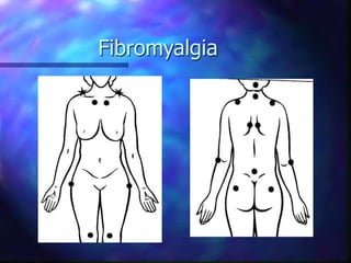 Fibromyalgia
 
