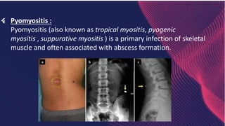 Infectious Pyomyositis Musculoskeletal infection basics by capt alauddin.pptx